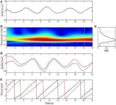 Frontiers | Association Between Phase Coupling Of Respiratory Sinus ...